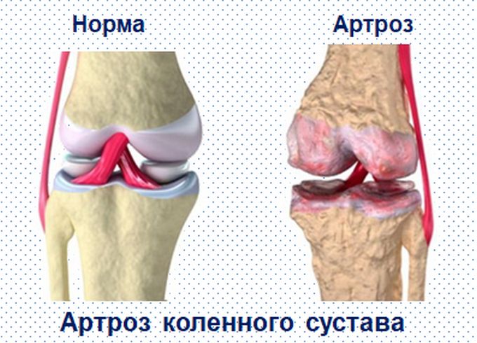 Артроз коленного сустава и здоровый коленный сустав