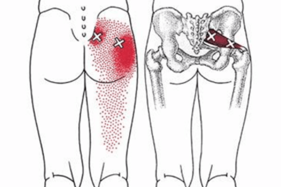 болевой синдром (ягодица, бедро, нога), грушевидная мышца