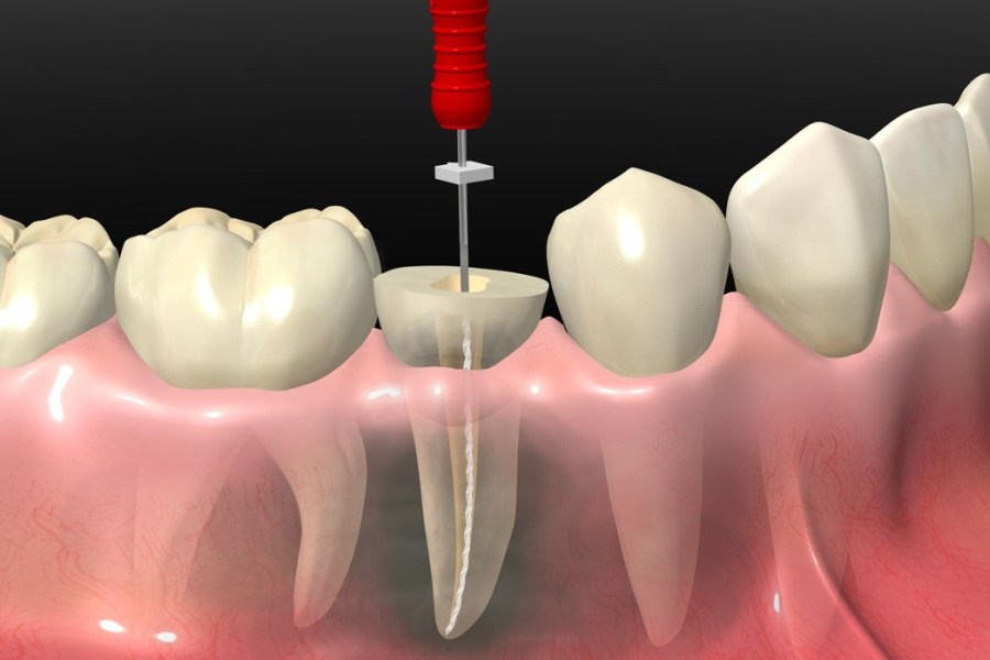 зубные каналы - процесс лечения