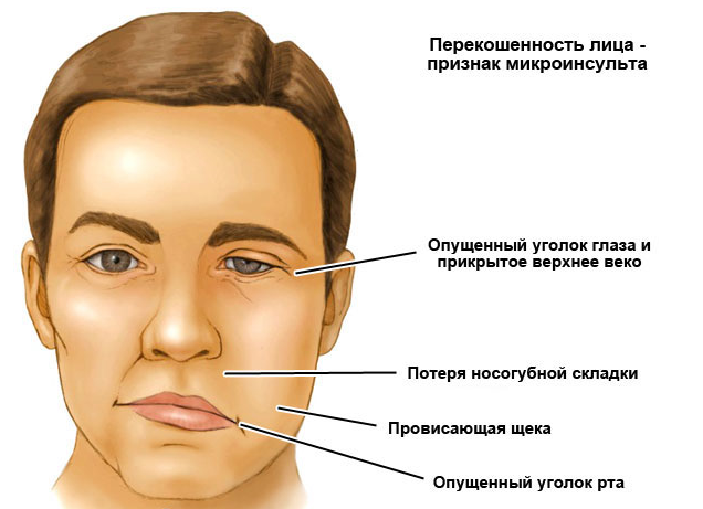 перекошенность лица - симптом микроинсульта