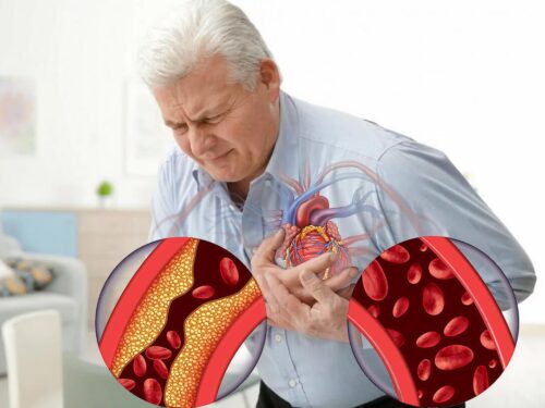 Нарушение кровоснабжения сердечной мышцы