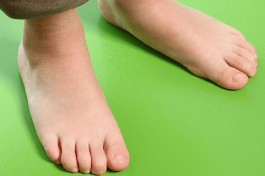 Что влияет на появление плоскостопия у детей