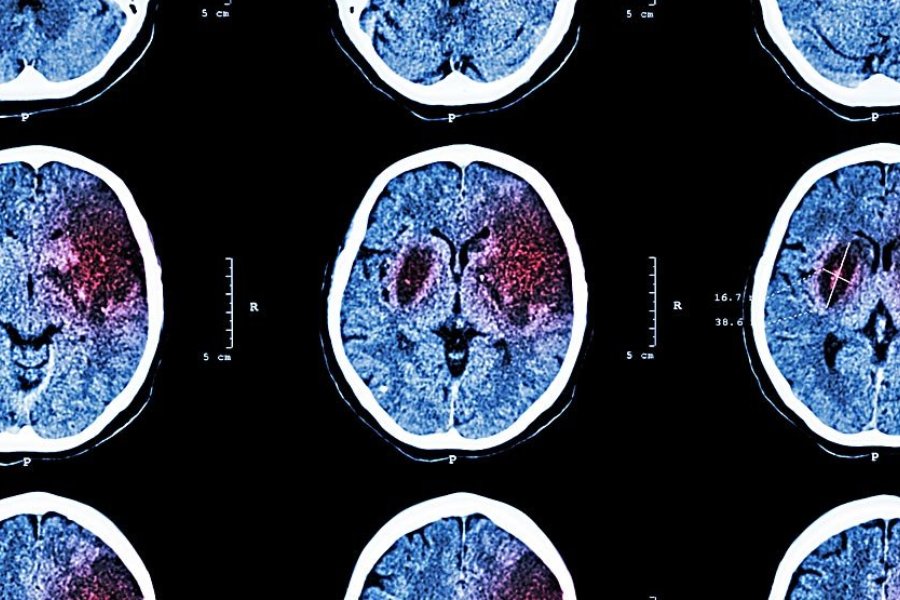 Поражение мозга последствия. Ишемический инсульт кт. Мозг после ишемического инсульта. Кт головного мозга при инсульте. Снимок мозга после инсульта.