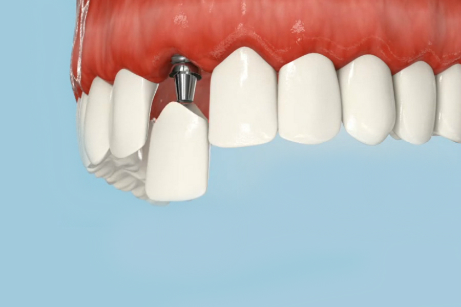 протезирование зубов на имплантатах